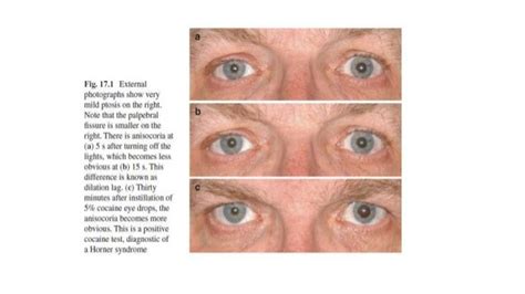 icd 10 abrasion|More.